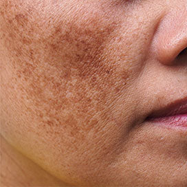 MELASMA