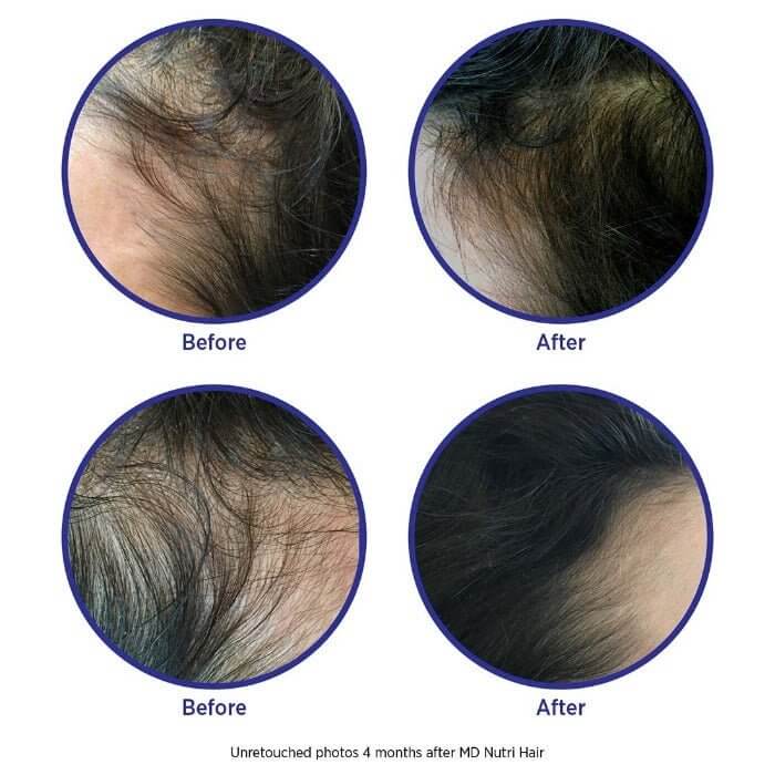 Before and after results of MD Nutri Hair from MD Hair—improved hairline fullness, reduced shedding, and visibly healthier scalp

